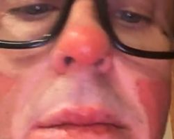 SLIPKNOT's SID WILSON: 'My Face Is Basically Melted' After Bonfire Explosion